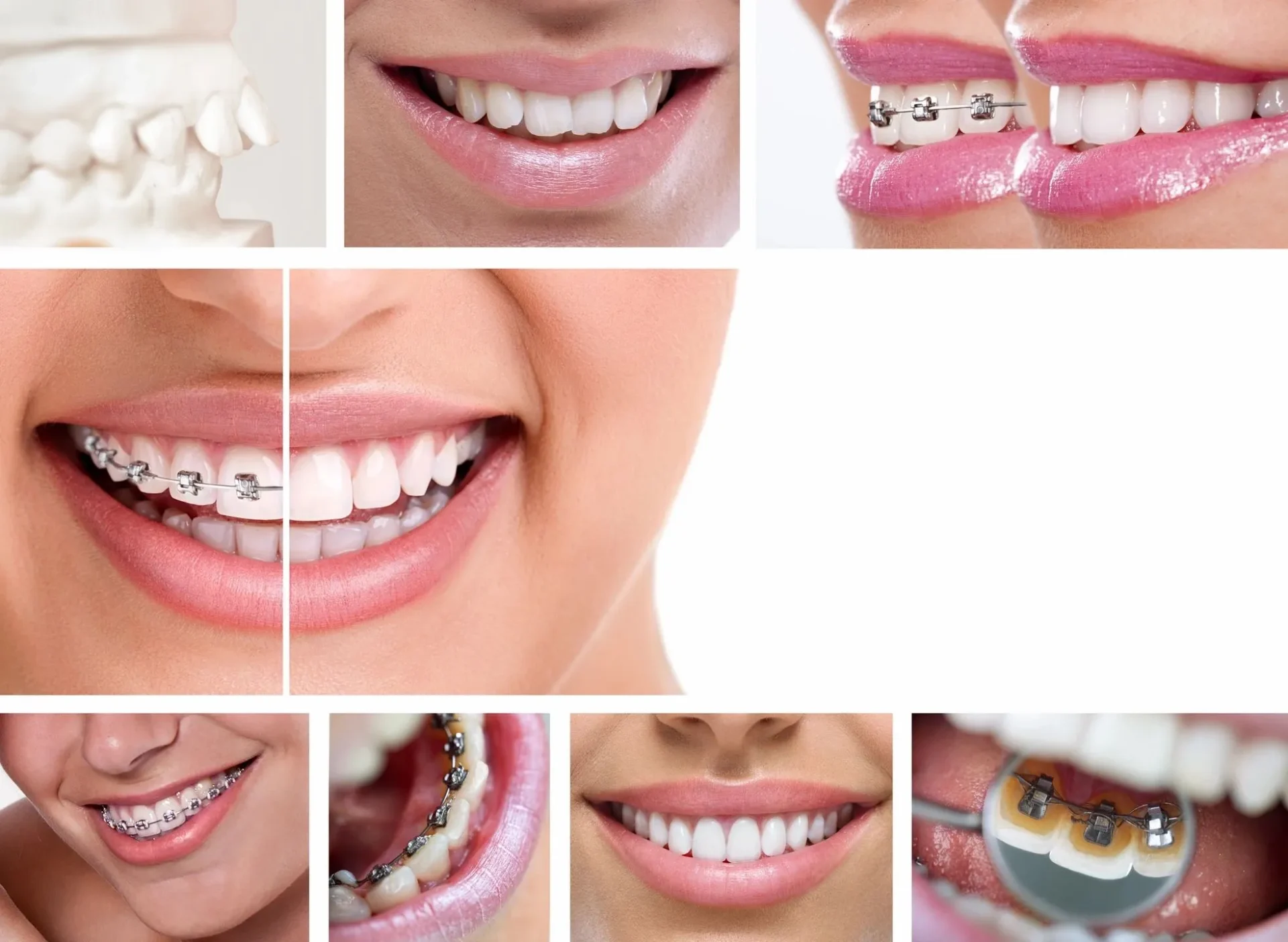 A collage of photos with teeth and dental braces.