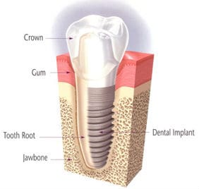 cosmetic-dental-implant_68