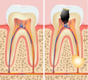wright_root_canal_Foto_27516421_BB