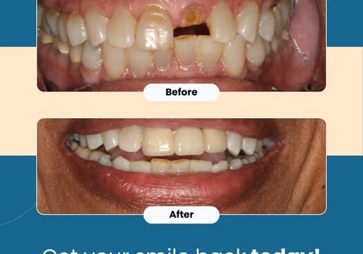 I broke my front tooth, Help!  Replacing a Broken Front Tooth: Why a Dental Bridge Could Be Your Best Option